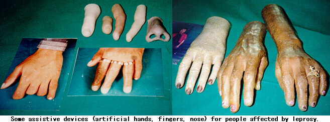 Leprosy.jpg
